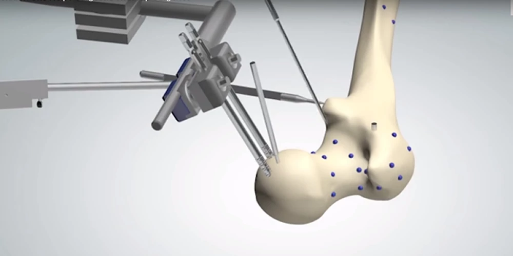 TSolution One robotic system for orthopaedic surgeryTSolution-One-robotic-system-for-orthopaedic-surgery.webp